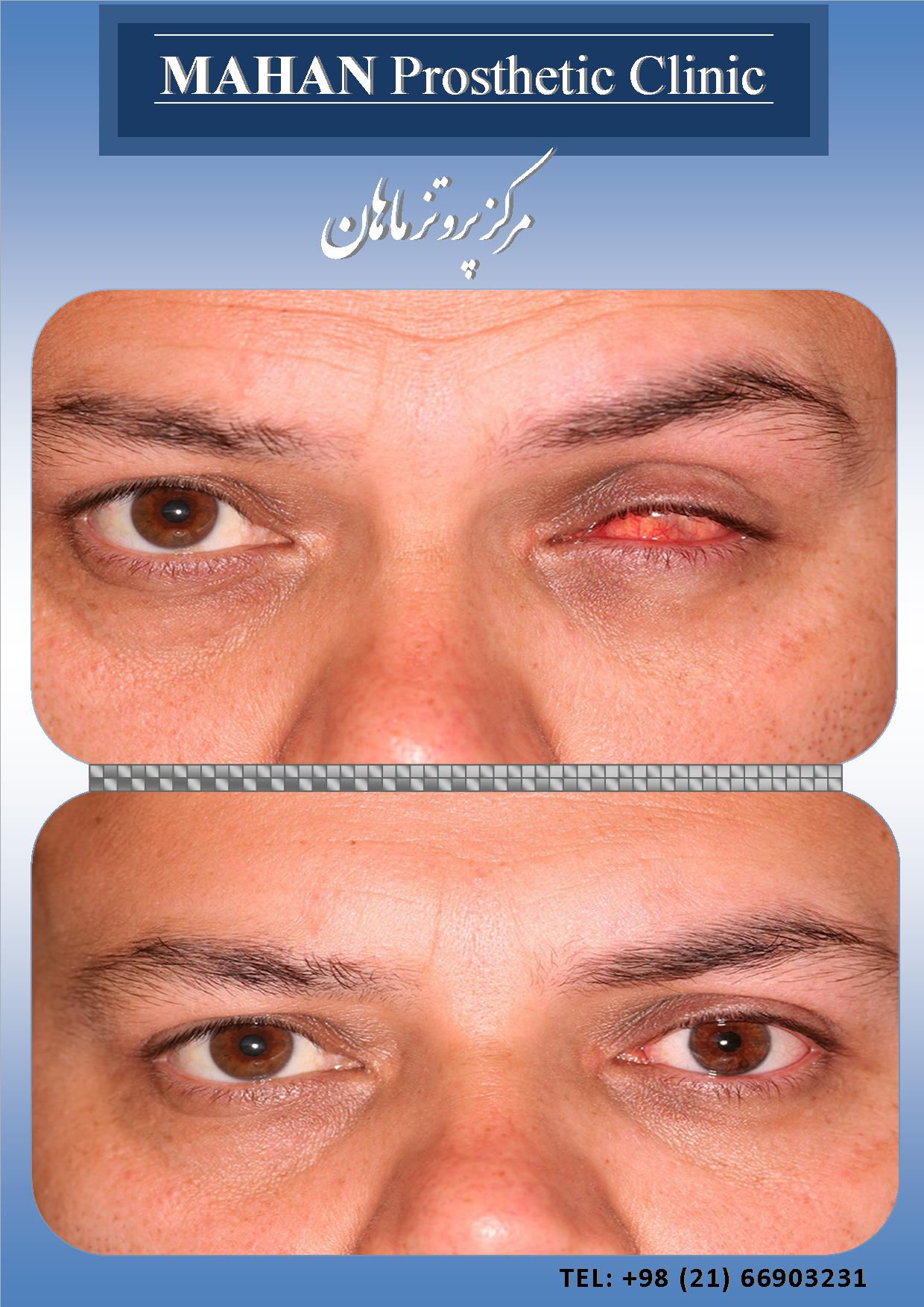 کلینیک ماهان - کلینیک تخصصی پروتز چشم شماره 3