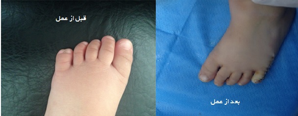 بیمار کودک 1 ساله ای است که با بدشکلی انگشت پا مرا