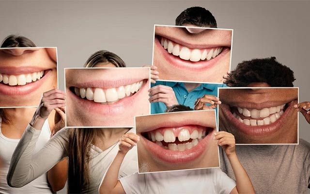 آموزش کامپوزیت ونیر - دندانسازی شماره 2