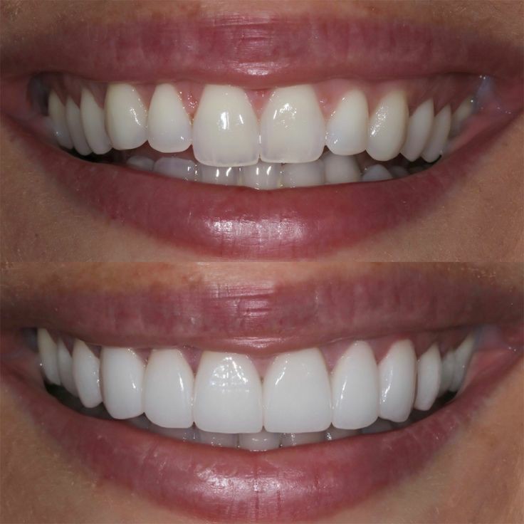 آموزش کامپوزیت ونیر - دندانسازی شماره 3